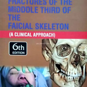 Killeys Fracture of the Middle Third of the Facial Skeleton 6th Edition